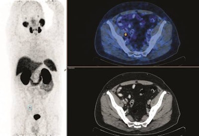 A 69-year-old man presented with rising PSA (0.16 ng/mL) following radical prostatectomy for prostate cancer classified as Gleason score 7 four years prior. PSMA PET/CT showed a solitary pelvic node with no prostate fossa recurrence. The patient underwent salvage radiotherapy including both fossa and pelvic node fields. PSA continued to rise, and repeat PSMA imaging showed new sites of PSMA-avid nodal disease in the common iliac region, directly above the radiotherapy field. Images courtesy of Emmett et al and JNM.
