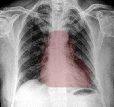 Heat maps generated by chest x-ray AI software. The occlusion-visualization heat map method (above) color codes the image patch that is considered to be the most significant abnormality on the image. The integrated gradients heat map method (below) accounts for the sensitivity of each pixel for predicting an abnormality and obtains an approximate attribution score for each pixel. It then generates a sensitivity heat map. Images courtesy of Dr. Shalini Govil.