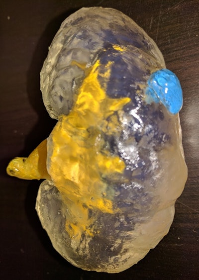 A 3D kidney model made from a low-cost desktop stereolithography printer. The model comprises multiple components: a kidney (clear), a renal collecting system (yellow), and a tumor (blue). Image courtesy of Dr. Anish Ghodadra.