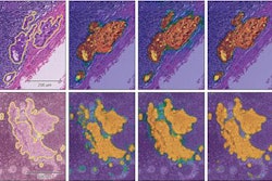 2017 12 11 21 47 6732 Jama Ai Breast Cancer 20171211212519