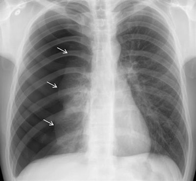Above: Chest radiograph of a large pneumothorax (white arrows). Below: Corresponding class activation map overlay from the pretrained GoogLeNet (Inception V1) deep-learning model. The purple and yellow areas indicate regions activated by the network, including the location of the pneumothorax as well as the nonaffected lung. It's possible that the network compares the differences between the pneumothorax and the nonaffected lung, although interpretation of such maps is an active area of research, according to the TJU researchers. Images courtesy of Dr. Paras Lakhani.