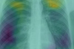 2017 12 19 23 05 3769 Pneumothorax2 New 20171219231548