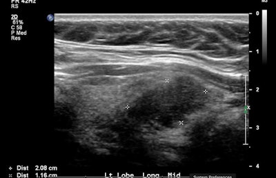 A malignant thyroid nodule (top) that is very hypoechoic and has a lower ratio of nodule echogenicity to parenchymal echogenicity than a benign nodule (below). All images courtesy of Dr. Zachary Nuffer.