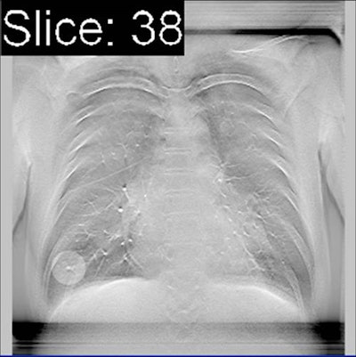 CAD highlights suspicious lung nodule finding on digital tomosynthesis slice. Image courtesy of Dr. Yoshitake Yamada.