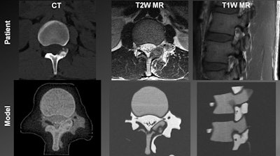 Top from left to right: Patient spine visualized in a CT scan, a T2-weighted MR image, and a T1-weighted MR image. Bottom from left to right: 3D-printed spinal model visualized in a CT scan, a T2-weighted MR image, and a T1-weighted MR image.