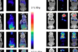 2018 01 08 22 06 2673 Pet Ct Lung Infection Inflammation 20180108224736