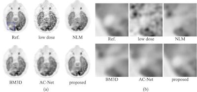 Comparison of the Stanford deep-learning method with existing low-dose PET enhancement algorithms. The full-dose reference PET image is shown on the upper left, followed by the 200x lower-dose image and the results of different image denoising/restoration methods such as non-local-mean (NLM) denoising, block-matching and 3D filtering (BM3D) denoising, a previously proposed deep autocontext convolutional neural network (AC-Net), and the proposed Stanford model. The Stanford researchers believe visual comparison of both the entire image (a) and the zoomed-in regions (b) show the superior image quality restoration of their algorithm. All images courtesy of Enhao Gong.