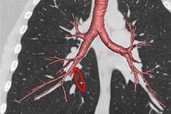 2018 01 16 23 31 1561 Ct Lung Copd 20180116234715