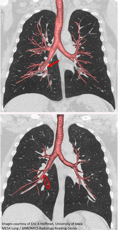 CT scan of standard central airway with medial basal airway present (red arrow; top). Absent medial basal airway variant (red circle; bottom). Image courtesy of Eric Hoffman from the University of Iowa.