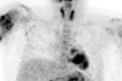 2018 01 17 18 31 4148 Pet Osteosarcoma Shulkin 400