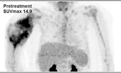 8-year-old with osteosarcoma at baseline