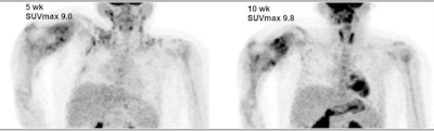 Images are from an 8-year-old girl with right humeral osteosarcoma. SUVmax declined from 14.9 at baseline to 9.0 after five weeks of therapy and then rose slightly to 9.8 after 10 weeks of therapy. The resected tumor specimen was 61% necrotic. The patient died of recurrent disease approximately 15 months after diagnosis. Images courtesy of JNM.