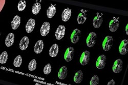 2018 01 25 17 55 9042 Brain Scan Stroke 20180125172247