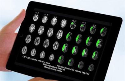 Advances in brain imaging technology may help identify more patients who are eligible for stroke treatment. Image courtesy of Dr. Gregory Albers.