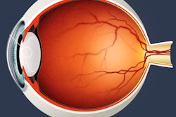 2018 01 25 21 56 2124 Eye Cataract 400