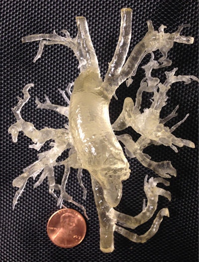 3D-printed model of a heart with tetralogy of Fallot and multiple aortopulmonary collaterals. Image courtesy of Dr. Wilson King.