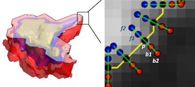 After the nodule is manually segmented, the 3D volume is automatically partitioned into nested 'shells.' All images courtesy of Mehdi Alilou, PhD.