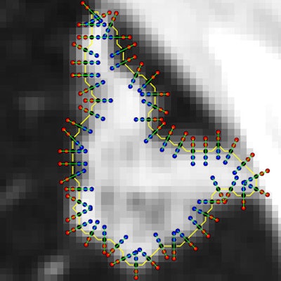 Nodule-interface sharpness features -- including texture and intensity transition -- are computed along the normal line for each border voxel on each shell.