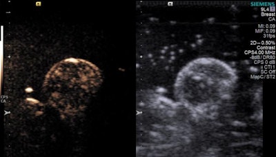 A round breast tumor with oxygen microbubbles spread throughout (gold dots or clouds) in an animal model of the disease. Image courtesy of the John Eisenbrey lab at Thomas Jefferson University.