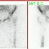 Infected Prosthesis