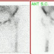 Infected Prosthesis