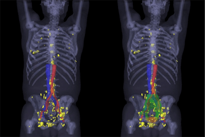 3D map of the PSMA-positive lesions (yellow) in the 52 patients with recurrent prostate cancer outside of the consensus clinical target volume. Image courtesy of Calais et al and JNM.