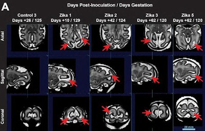 Researchers found telltale signs of Zika (periventricular subcortical T2-hyperintense foci in the posterior brain) on serial brain MRI scans with a HASTE protocol but said the phenomena were transient.