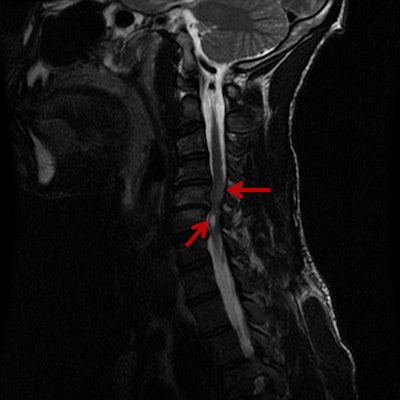 MRI of a 34-year-old male cyclist who was wearing a helmet. Sagittal T2 image shows high T2 signal throughout the cervical spinal cord consistent with edema. There is cavitary high T2 signal in the spinal cord in addition to the traumatic findings. Image courtesy of Dr. Kishore Chundru.