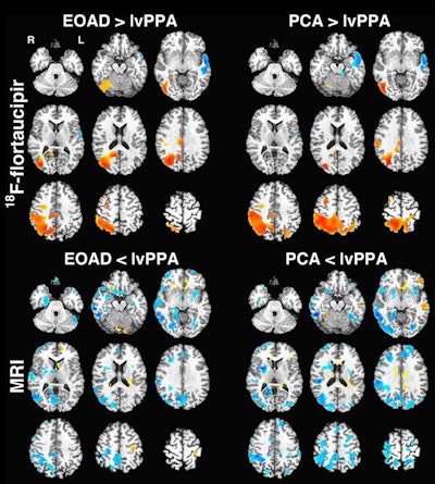 Voxel-based images show comparison of flortaucipir-based standardized uptake values (SUV) (top) and gray-matter density (bottom). Regions with higher SUV or gray-matter density in early-onset Alzheimer's disease (EOAD)/posterior cortical atrophy (PCA) versus lvPPA (logopenic variant of primary progressive aphasia) are in red-yellow, with those higher in lvPPA in blue. There was no significant difference between early-onset Alzheimer's and posterior cortical atrophy groups for PET or MRI. Images courtesy of JNM.