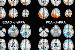 2018 02 06 01 05 9862 Flortaucipir Alzheimers Pet Jnm 20180206010340