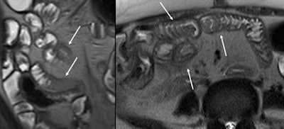 Coronal and axial T2-weighted HASTE images at cytomegalovirus enteritis in HIV positive patient showing mural thickening with T2 hyperintense appearance (arrows).