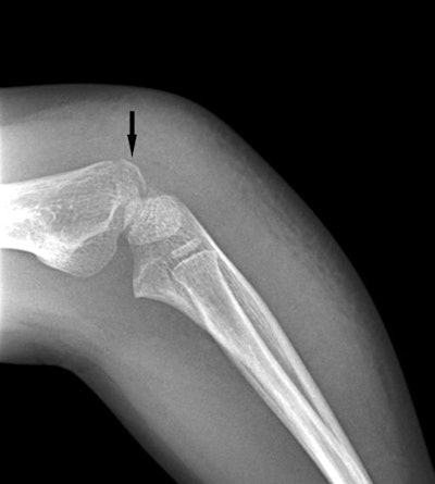 Four-year-old girl with a nondisplaced lateral condylar fracture. Above, x-ray performed by a pediatrician at a freestanding pediatric urgent care center with nonorthogonal positioning of the left elbow, showing possible lateral condylar fracture, but only on one image (arrow). Beam collimation was not used, leading to unnecessary radiation to the majority of the forearm. The patient was sent to the main hospital for additional imaging; with proper orthogonal positioning and collimation performed by a technologist, the fracture is delineated (below, arrow) and the diagnosis made with greater confidence. Images courtesy of Dr. J. Herman Kan.