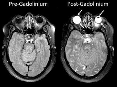 MRI scans show gadolinium leakage in the eyes after the contrast agent is administered to a stroke patient. Images courtesy of the NINDS.