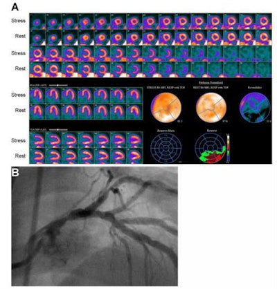 Images are from an 81-year-old man with hypertension and dyslipidemia. Myocardial perfusion imaging (A) with rubidium-82 PET showed mild, reversible perfusion abnormality in the left anterior descending coronary artery. Nearly the entire heart had severely reduced myocardial functional recovery (MFR) except for inferior and inferolateral walls, where it was moderately reduced. Coronary angiography (B) showed severe stenosis of the midportion of the left main coronary artery. Images courtesy of SNMMI and ASNC.
