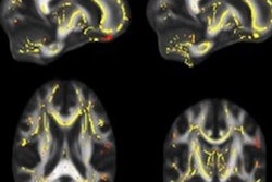 2018 02 16 22 57 7981 Dti Mri White Matter 20180216221733