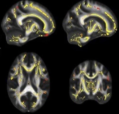DTI-MRI highlights areas (yellow and reddish pixels) where the functionality of white matter is associated with higher fitness levels. The images are based on cumulative data from patients to show potential links between physical fitness and deterioration of white matter. Images courtesy of UT Southwestern Medical Center.