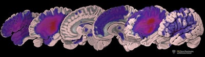 Images depict the distribution of lesions in the dataset: the redder the color, the greater the number of patients with lesions in that part of the brain. Courtesy of USC Mark and Mary Stevens Neuroimaging and Informatics Institute/Tyler Ard.