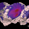 2018 02 21 19 48 7208 Mri Atlas Stroke 20180221190643