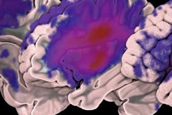 2018 02 21 19 48 7208 Mri Atlas Stroke 20180221190643