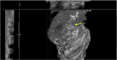 Lateral ABUS view of the left breast. There is a small, spiculated cancer present in the upper outer quadrant. In the coronal reconstruction (large field), an extensive retraction pattern is seen in the surrounding tissue (yellow arrow). This facilitates quick lesion detection and increases specificity of ABUS reading. Image provided by Dr. Ritse Mann.