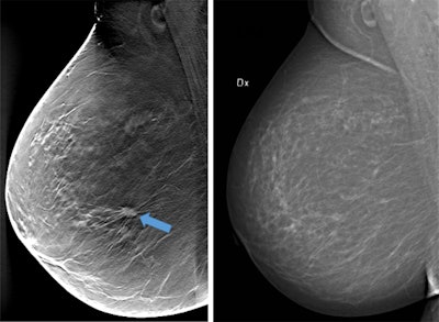 A 1-cm large tumor in a nondense breast is not evident on digital mammography but is clearly visible on digital breast tomosynthesis. This tumor could easily be missed at digital mammography screening. The case illustrates the fact that not much overlapping tissue is needed to hide a small, spiculated tumor on digital mammography. Images provided by Dr. Sophia Zackrisson.