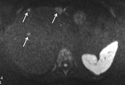 Obtained during a short protocol, this diffusion-weighted image shows a patient with conspicuous liver metastasis. The lesions are marked by arrows. Image courtesy of Dr. Thomas Lauenstein. Image originally published in ECR Today on 1 March 2018.