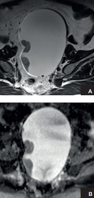 Patient with ovarian cancer. A: Axial T2-weighted high-resolution image shows a left adnexal lesion containing solid components. B: Apparent diffusion coefficient (ADC) map shows marked restricted diffusion in the solid components, highly suggestive of malignancy. Histopathology confirmed the presence of stage 1 high-grade ovarian cancer. Images courtesy of Dr. Evis Sala, PhD.