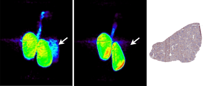 Whole-body PET (maximum intensity projection) images of monkey kidneys and spleen 90 minutes postinjection of anti-PD-L1 adnectin labeled with F-18 (left) and of the labeled protein with co-administration of a nonlabeled dose in the same monkey (center). Right image shows the anti-PD-L1 immunohistochemistry of healthy monkey spleen tissue. Credit: David Donnelly, PhD.