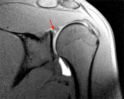 MR arthrogram image of a 27-year-old professional rugby player. There is superior labral tearing (arrow), representing a SLAP tear. Image courtesy of Dr. Andrew Grainger.