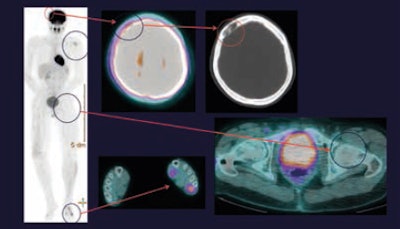 On PET/CT, the metastasis in the left humerus is FDG-positive, but the metastasis in the right cranial vault is FDG-negative and only seen on the corresponding CT scan. The metastasis in the left femur is invisible on the PET/CT scan. Note increased FDG uptake in left leg and foot secondary to muscle activity.