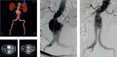 Figure 1 (above): Ruptured abdominal aortic aneurysm before and after stent graft implantation. Figure 2 (below): Ruptured abdominal aortic aneurysm: classical surgery versus percutaneous stent graft implantation under fluoroscopy guidance. Images courtesy of Dr. Krzysztof Pyra.