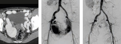 Figure 3: Yakes type IIIa arteriovenous malformation: multiple arteriovenous fistulas into the wall of a single outflow aneurysmal vein -- before and one year after embolization. Image courtesy of Dr. Krzysztof Pyra.