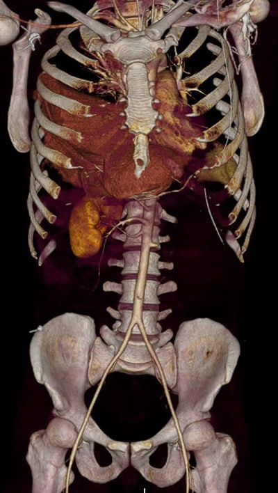 Volume-rendered, thick slab reconstruction of a thoracoabdominal trauma CT scan of a polytrauma patient with, among other injuries, a right-sided diaphragmatic rupture with herniation of the liver and the gallbladder into the thoracic cavity and also dissection of the left renal artery. Image courtesy of Dr. Monique Brink.