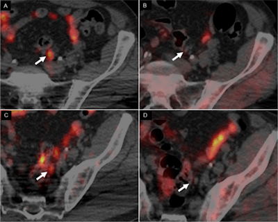 Images are of a 62-year-old man with Gleason 4+3 prostate cancer who was treated with radical prostatectomy, with a rising PSA level (1.32) and PSA doubling time of 3.7 months. PET/CT images with Cu-64 chloride revealed two positive small left iliac lymph nodes (A, C -- left), whereas F-18 choline PET/CT (B, D -- right) was negative (arrows). Images courtesy of JNM and Piccardo et al.